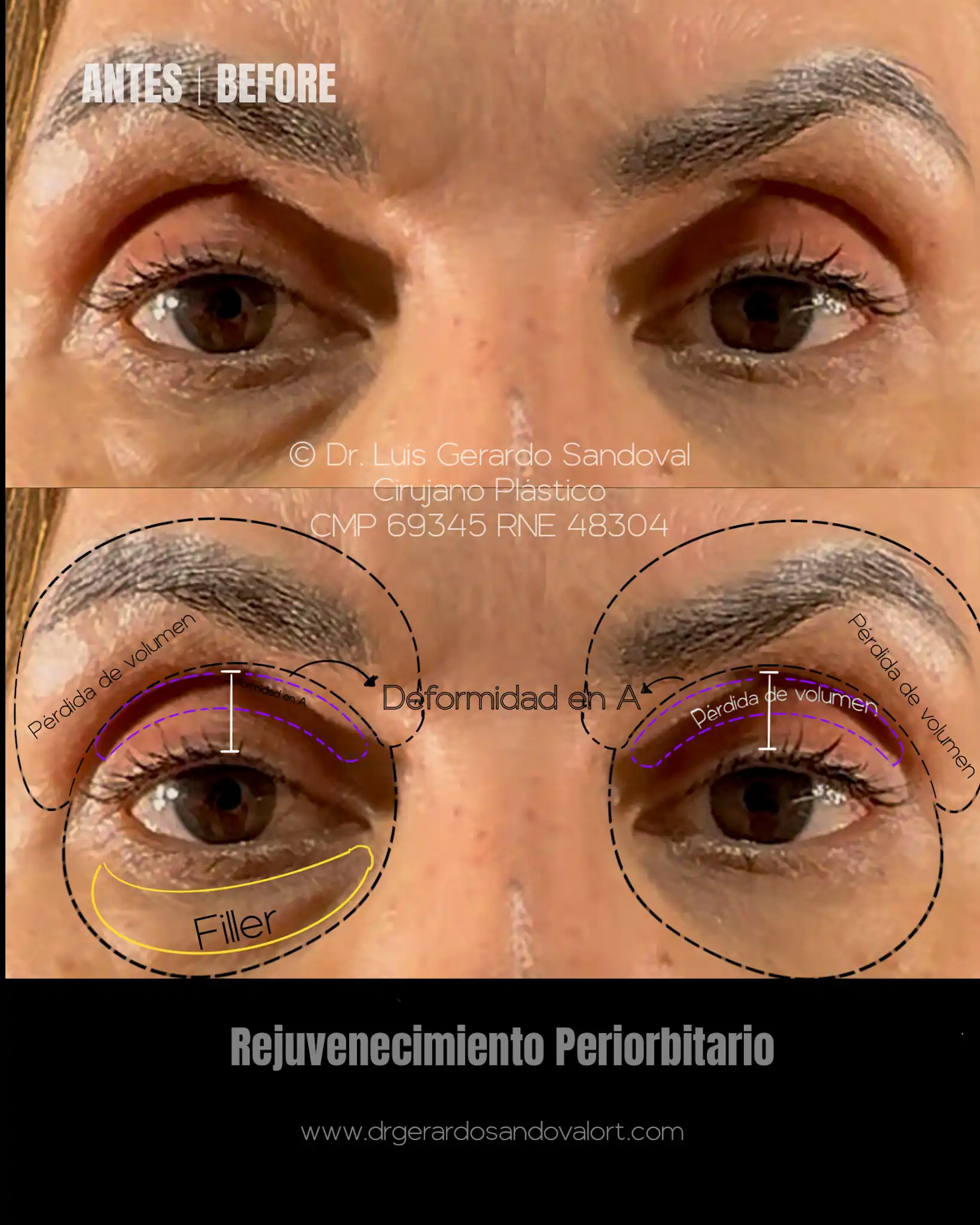 Antes del rejuvenecimiento periorbitario con blefaroplastia transcutánea, deformidad en A del párpado superior y restos de filler infraorbitario, evaluado por el Dr. Luis Gerardo Sandoval en Lima.