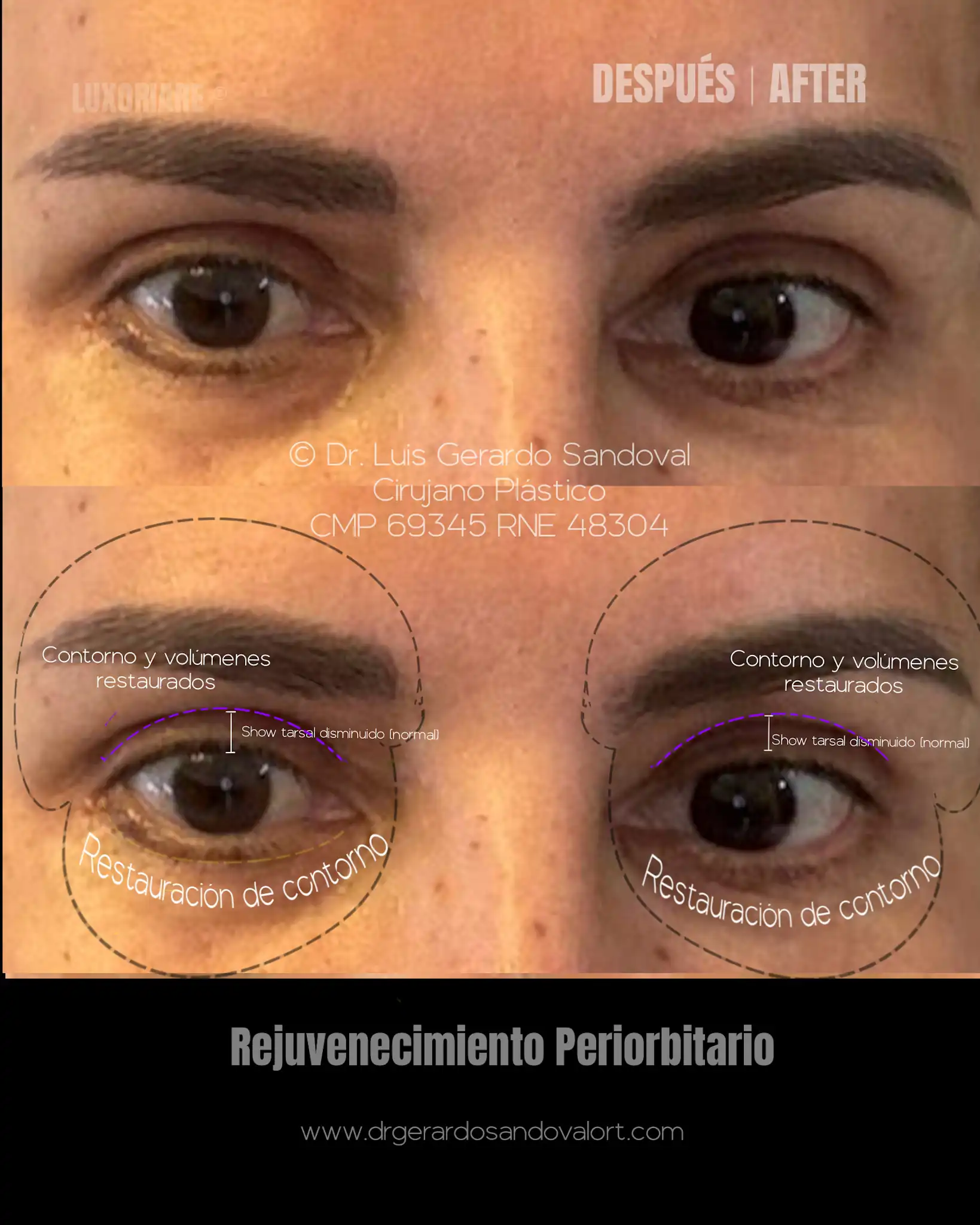 Después del rejuvenecimiento periorbitario con blefaroplastia transcutánea, cantopexia y lipofilling, con contornos restaurados y mirada más armónica, realizado por el Dr. Luis Gerardo Sandoval en Lima.