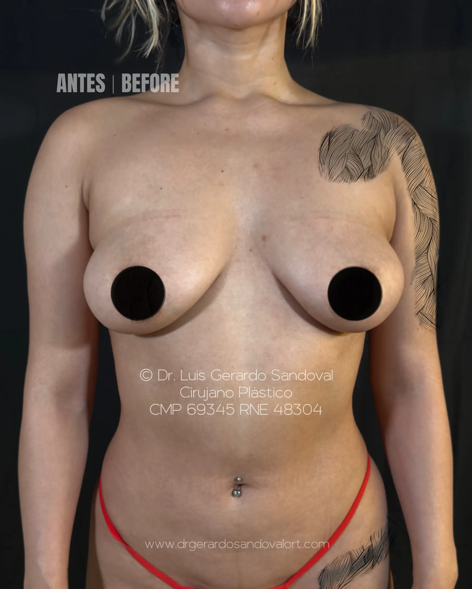 Antes del aumento mamario primario en Lima. Vista frontal preoperatoria con escasa proyección del polo superior y apariencia de pseudoptosis, evaluada por el Dr. Luis Gerardo Sandoval.