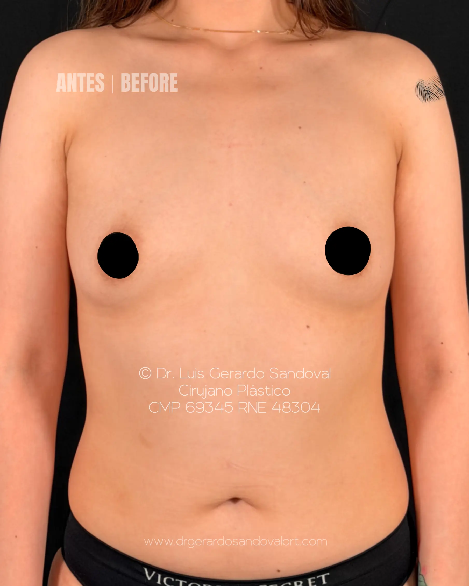 Antes del aumento mamario PRESERVÉ™ en Lima. Vista frontal preoperatoria con volumen mamario reducido evaluada por el Dr. Luis Gerardo Sandoval.
