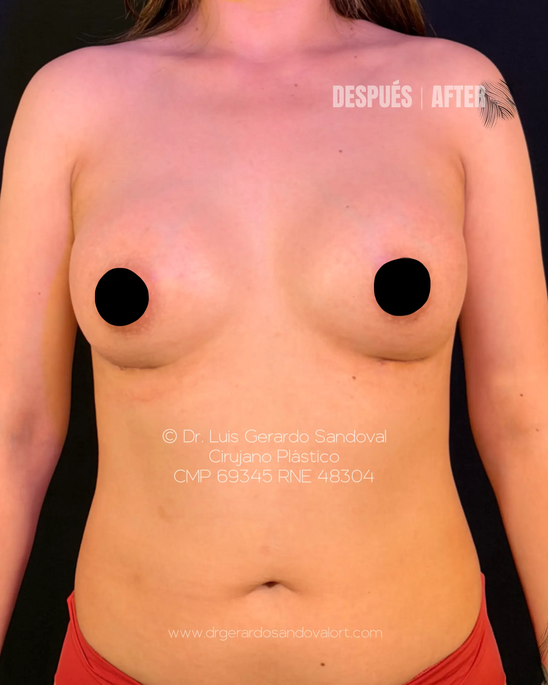 Después del aumento mamario PRESERVÉ™ en Lima con implantes Motiva® Ergonomix®2 de 290 cc proyección Full realizado por el Dr. Luis Gerardo Sandoval.